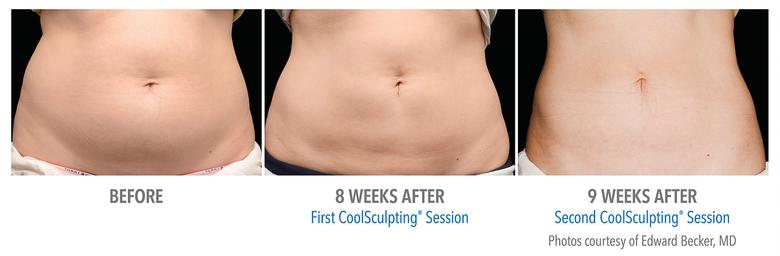 CoolSculpting