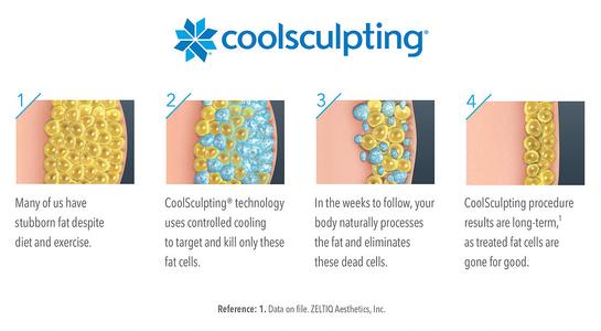 CoolScultping